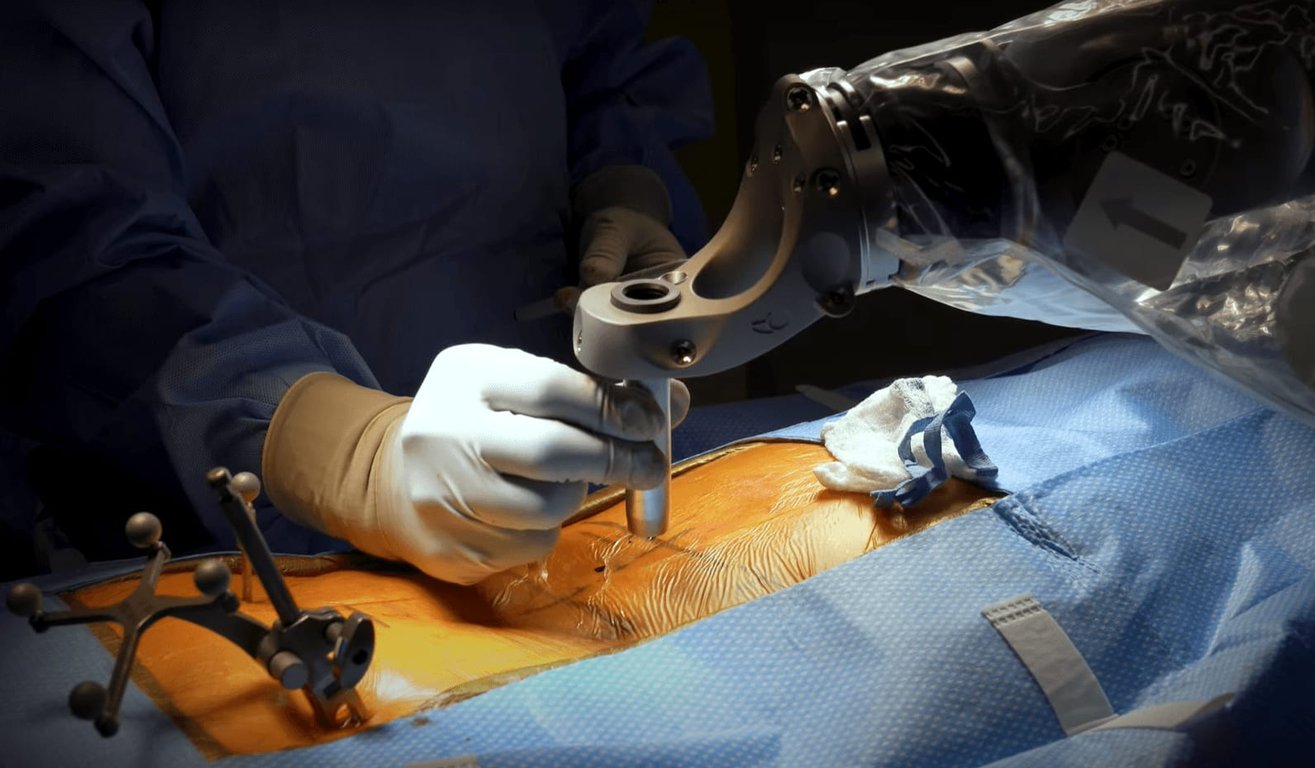 Globus robotic navigation for complex spine deformity surgery